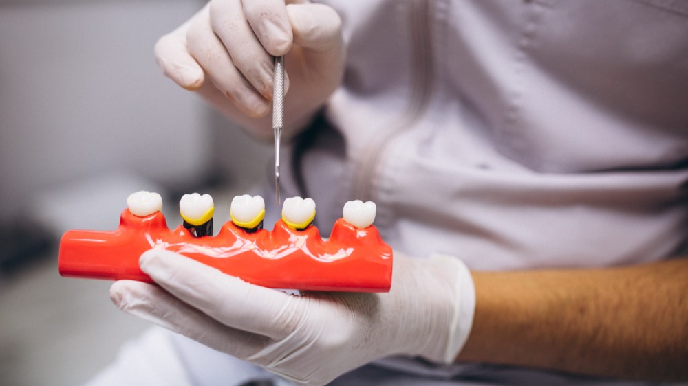 Vollständige Zahnimplantate | Dauerhafte und Ästhetische Lösung – PYS Dent