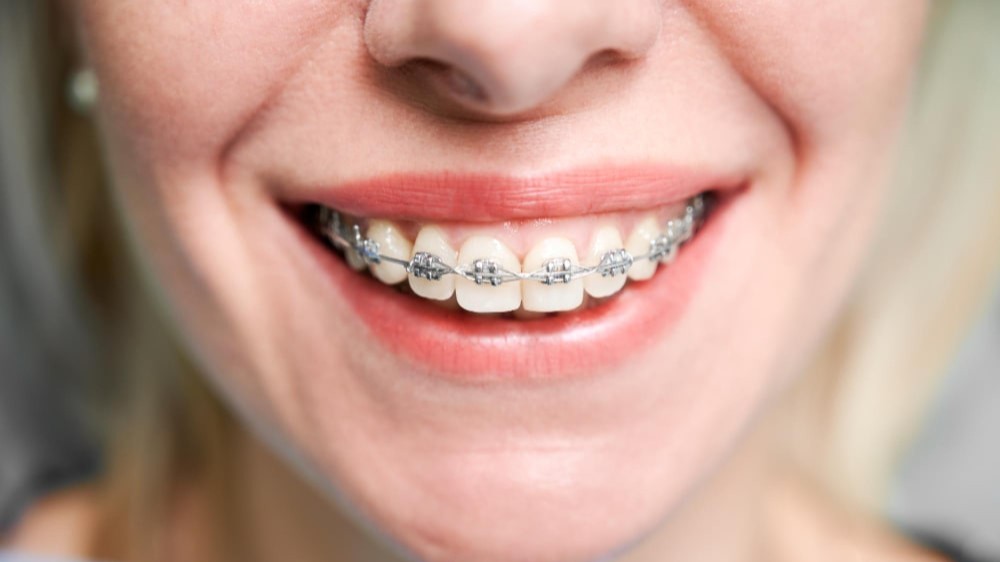 Was ist Kieferorthopädie und wann wird sie angewendet? | PYS Dent Zahnklinik