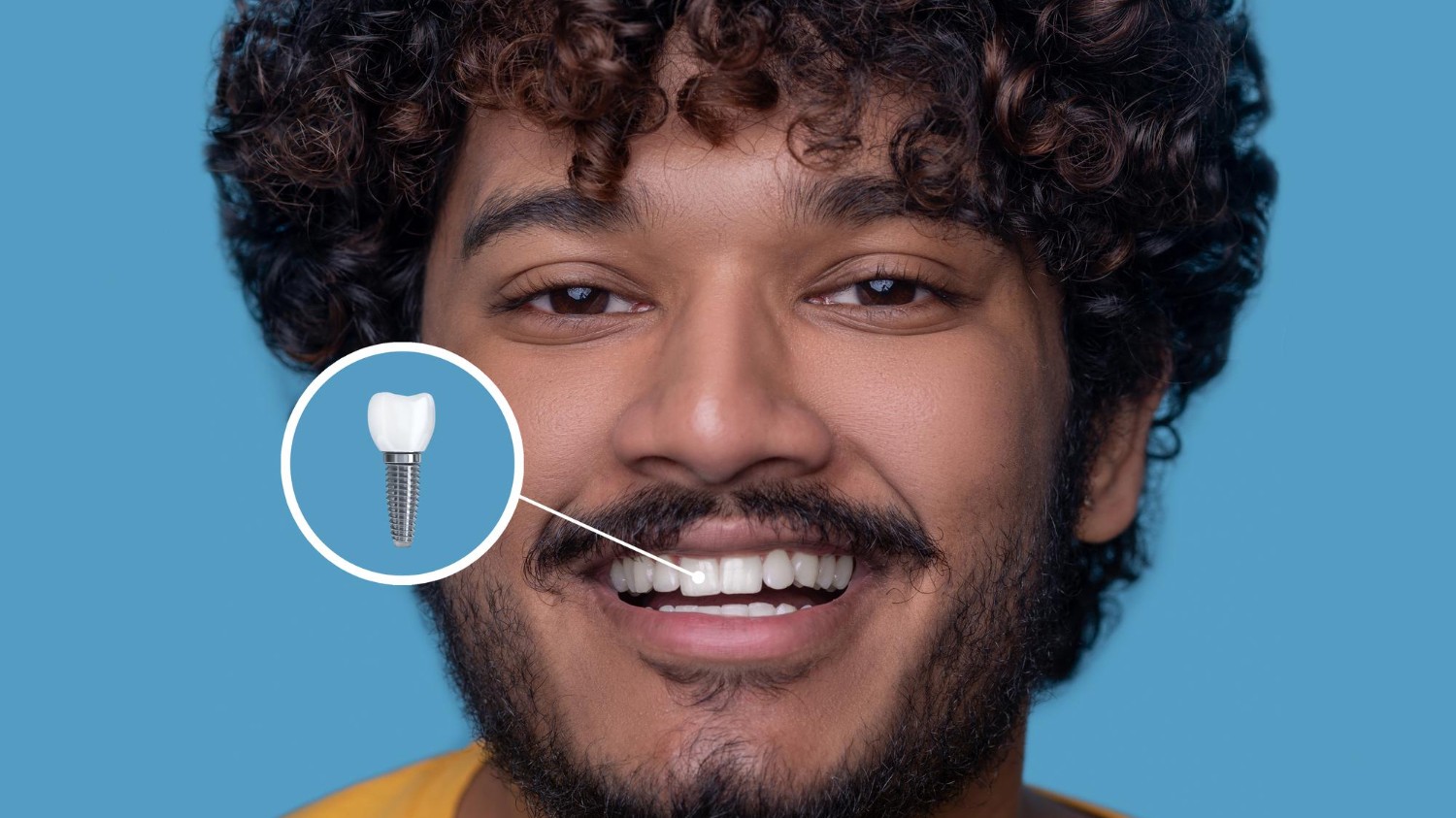 implant Tedavisi – PYS Dent Kayseri